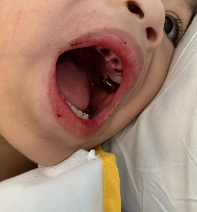 Selesai Pembedahan, 8 Batang Gigi Anak Fedtri Yahya Terpaksa Dibuang Akibat Jangkitan Kuman &#038; Terlalu Hitam