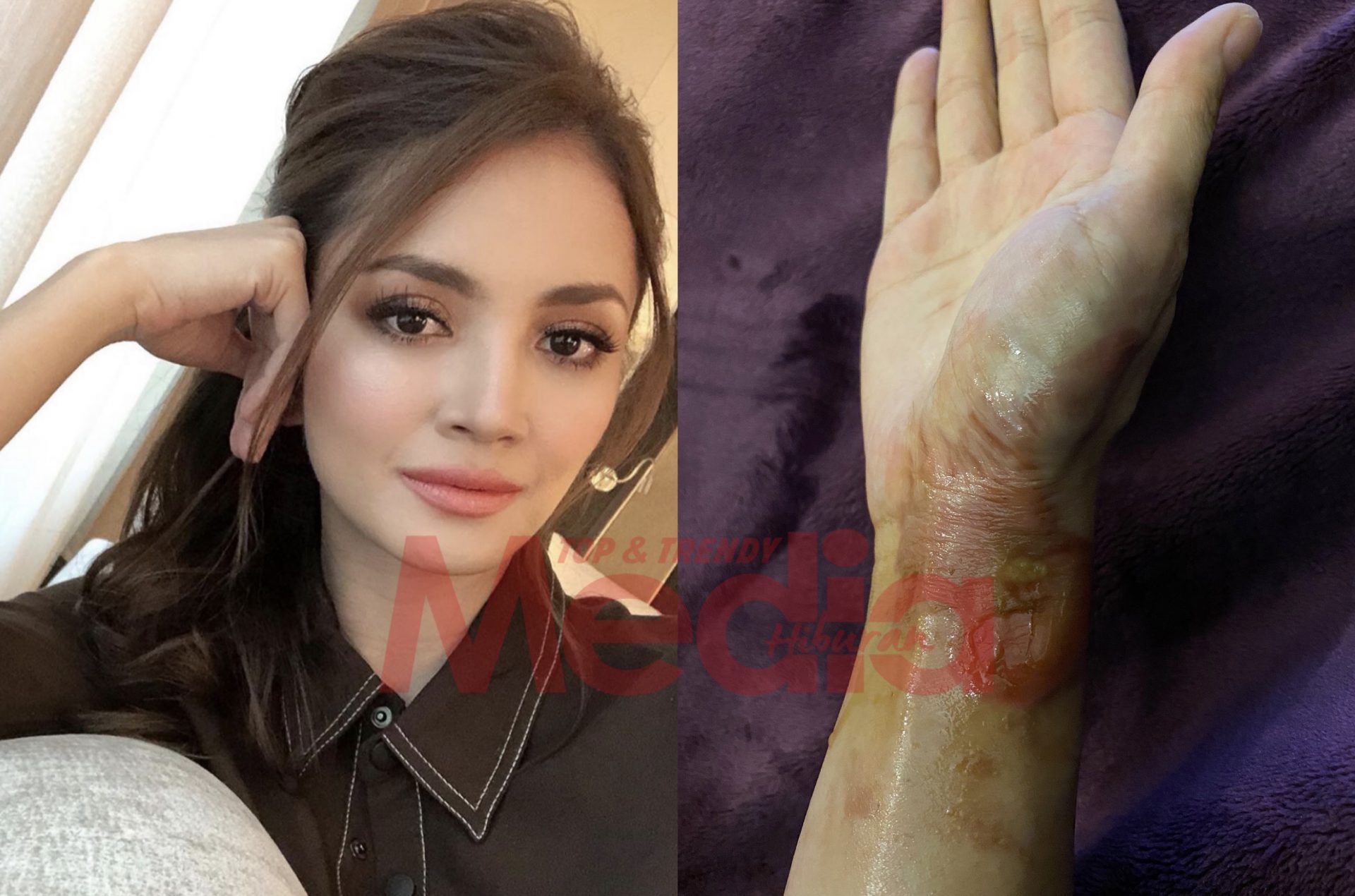 “Tak Lama Lagi Sembuh Ni,” – Tangan Tercedera Kerana Minyak Panas, Fazura Kongsi Gambar Terkini