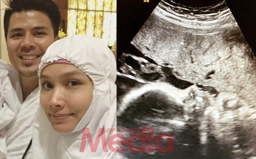 “Seperti Biasalah Dia Sorok Muka Lagi,” – Awal Kongsi Foto Terkini Ultrasound Bayi, Peminat Teruja & Tumpang Gembira