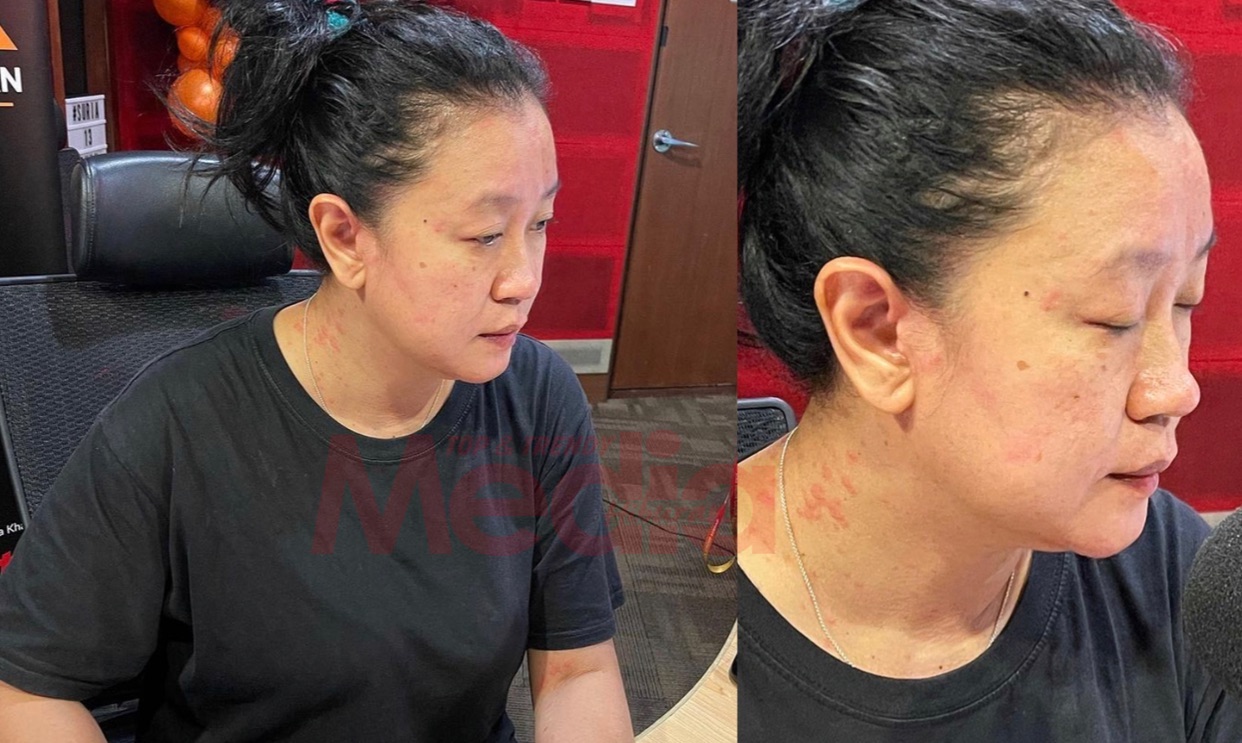 “Demi Peminat Gagahkan Jua,” &#8211; Biar Bintik-Bintik Merah Naik Sampai Tangan Dan Muka, Dalam Alergik DJ Lin Tetap On Air