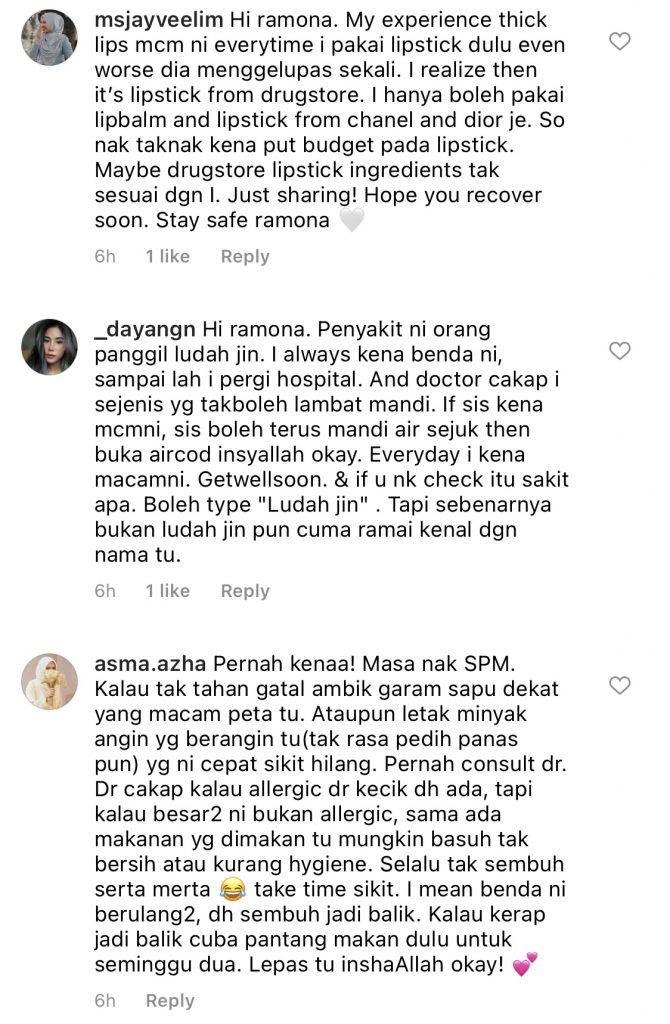 “Perasan 2 Hari Lepas Macam Dah Ada Bintik, Tapi Semalam Jadi Teruk&#8230;,” &#8211; Gatal Yang Amat, Ramona Kongsi Foto Terkini Mata &#038; Bibirnya Bengkak!