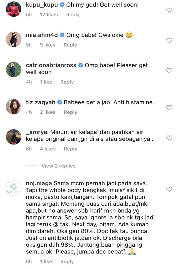 “Perasan 2 Hari Lepas Macam Dah Ada Bintik, Tapi Semalam Jadi Teruk&#8230;,” &#8211; Gatal Yang Amat, Ramona Kongsi Foto Terkini Mata &#038; Bibirnya Bengkak!