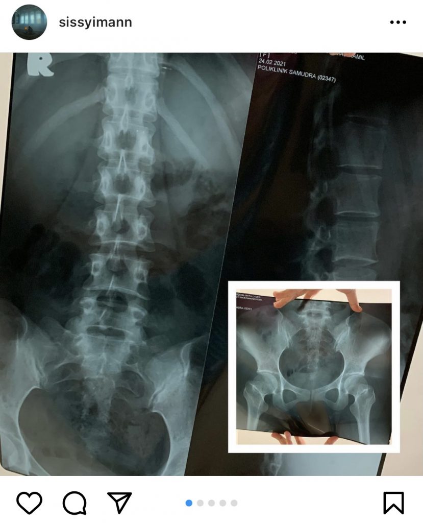 Sissy Imann Alami Kecederaan Waktu Menunggang Kuda – “Allah Nak Hapuskan   Dosa Rasanya Hari Ini…”